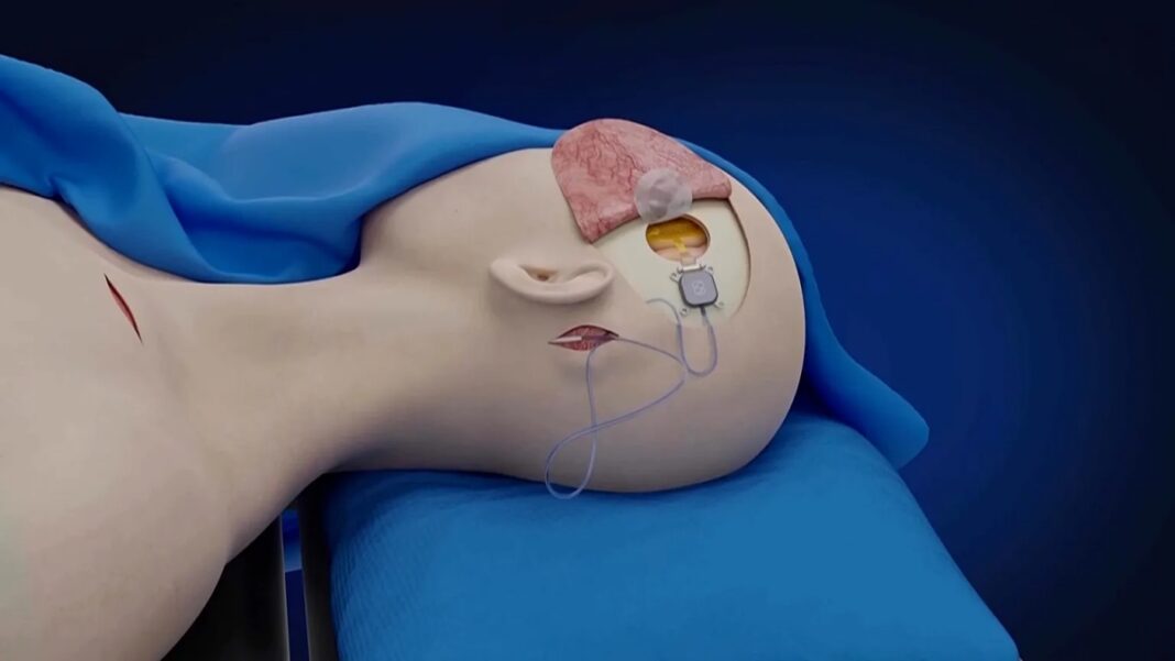 Otkriće u Kini: Paralizovani čovjek upravlja uređajima samo snagom mozga