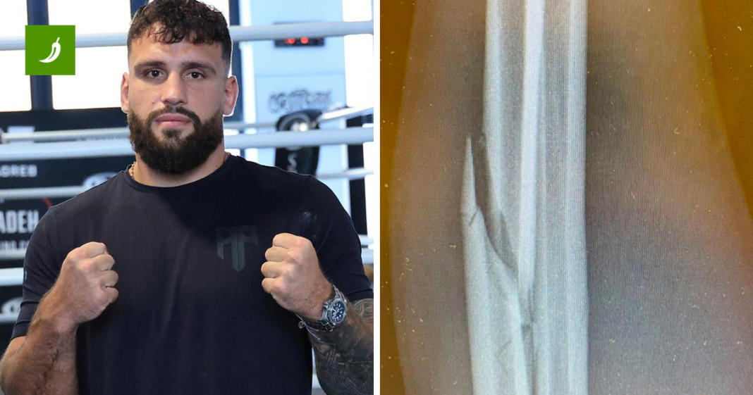 Plazibat se vratio i pobijedio. Ovako mu je izgledala ruka prije 911 dana