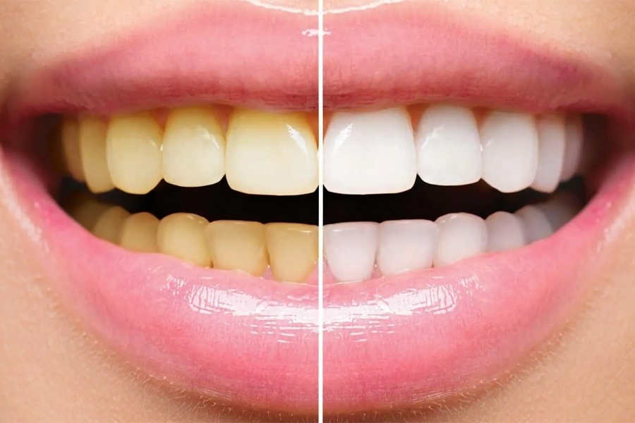 ZABORAVITE SKUPE VODICE: Čarobni napitak za vaša usta već imate u kuhinji!