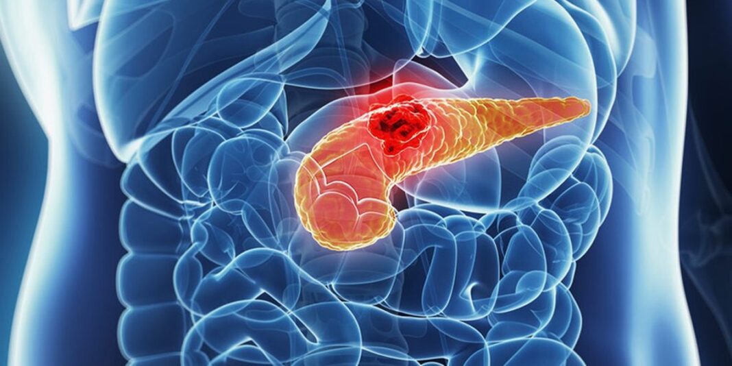 Istraživanje otvara vrata novim terapijama za jedan od najsmrtonosnijih karcinoma