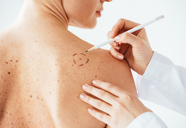 Rusi razvijaju prvi lijek za liječenje melanoma