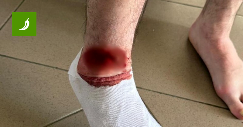 UZNEMIRUJUĆE Ovako je izgledala noga napadača Dugopolja nakon duela u drugoj ligi UZNEMIRUJUĆE Ovako je izgledala noga napadača Dugopolja nakon duela u drugoj ligi