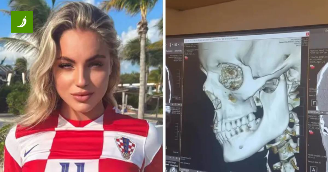 FOTO Hrvatska reprezentativka slomila nos. Liječnici su joj ga vraćali na mjesto FOTO Hrvatska reprezentativka slomila nos. Liječnici su joj ga vraćali na mjesto